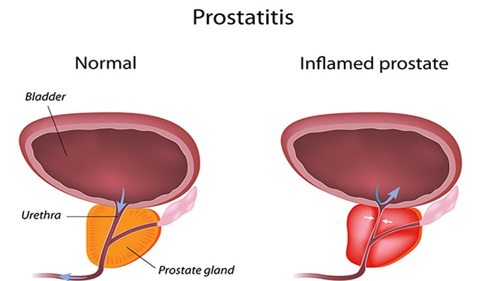 prostatita de la ce)